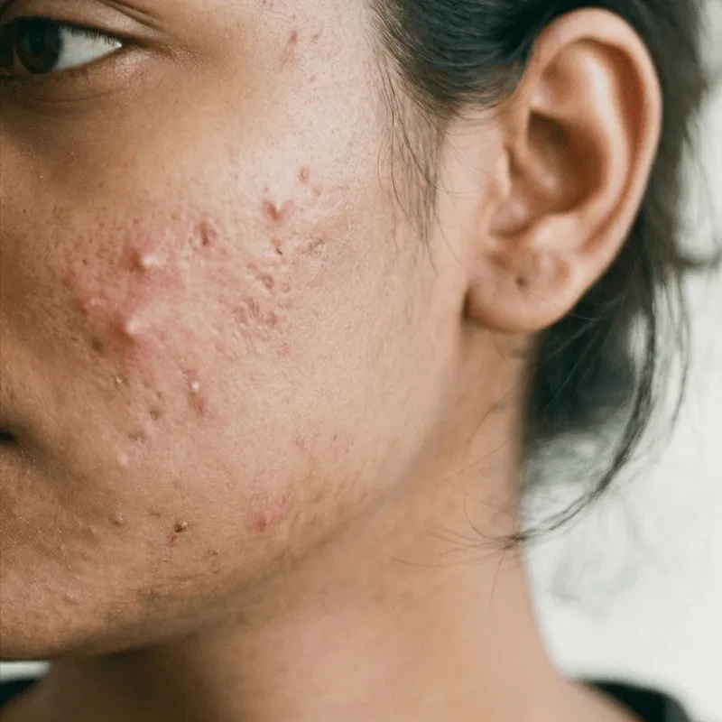 Acne Before