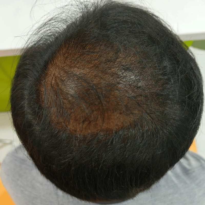 Hair Loss After