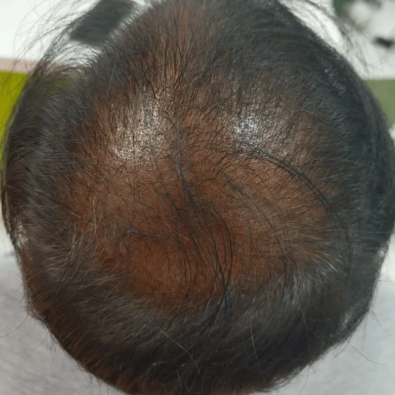 Hair Loss Before